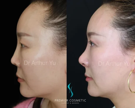 Art TipLyft® case #18269