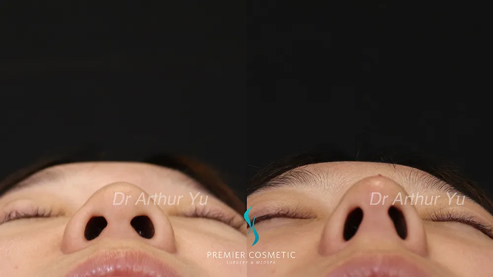 Art TipLyft® case #17267