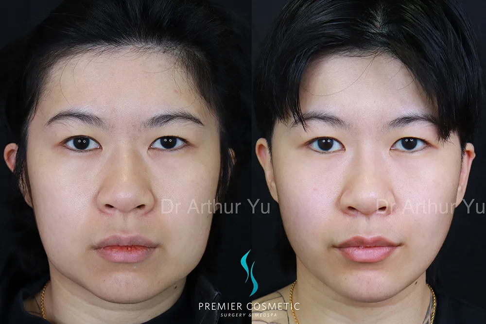 SMAS PDO Thread Lift case #17356