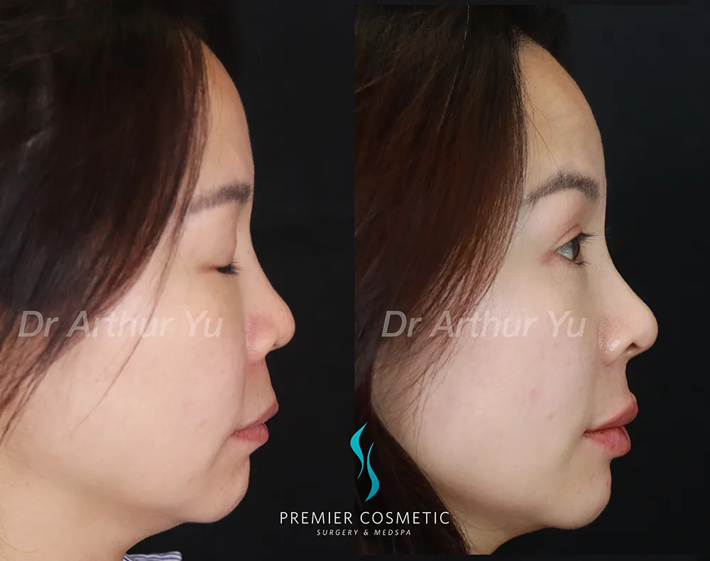 Art TipLyft® case #17265