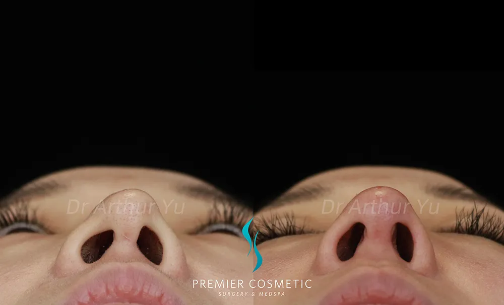 Art TipLyft® case #17259