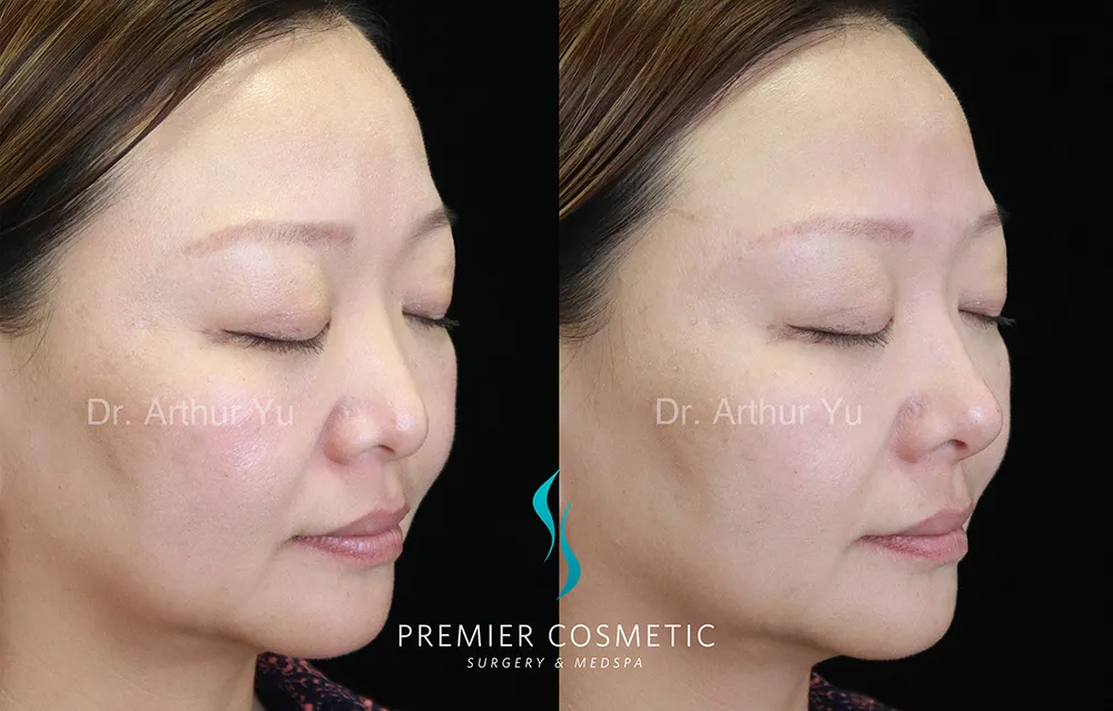 Art TipLyft® case #17257