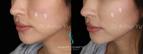 Dermal Filler case #17365