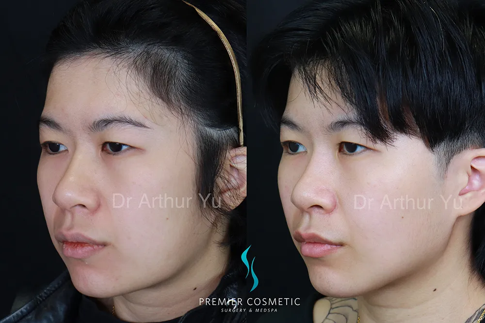 SMAS PDO Thread Lift case #17356