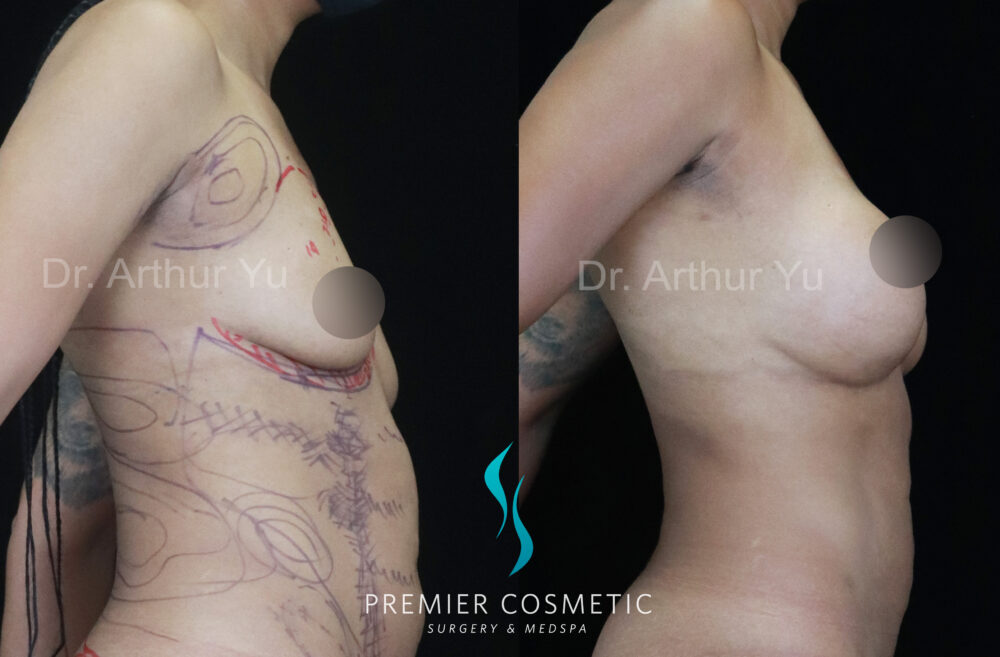Breast Augmentation case #17916