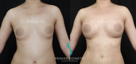 Breast Fat Grafting case #17953