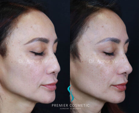 Art TipLyft® case #17906