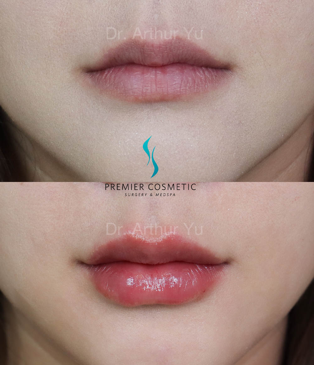 Lip Filler case #18011