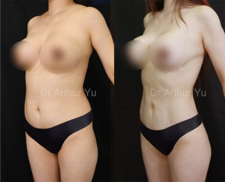 Liposculpture case #18013