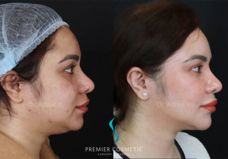 Buccal Fat Removal case #17993