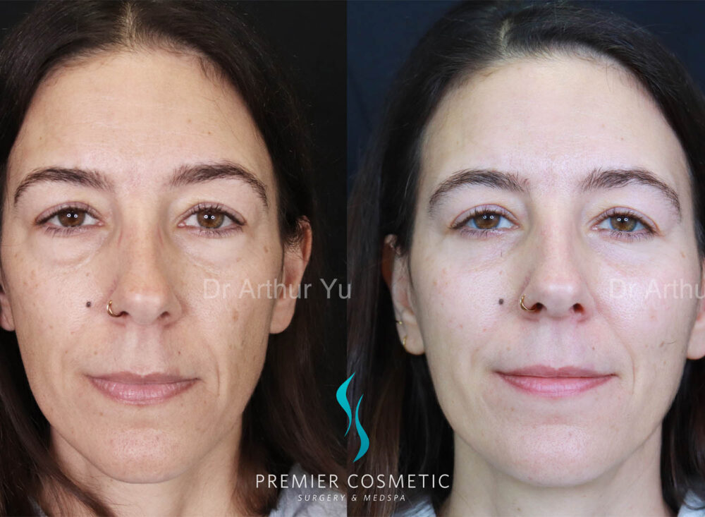 Lower Eyebag Surgery case #18035