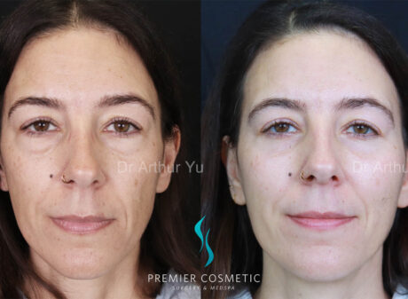 Lower Eyebag Surgery case #18035