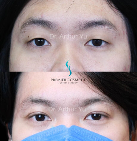 Upper Eyelid Surgery case #18069