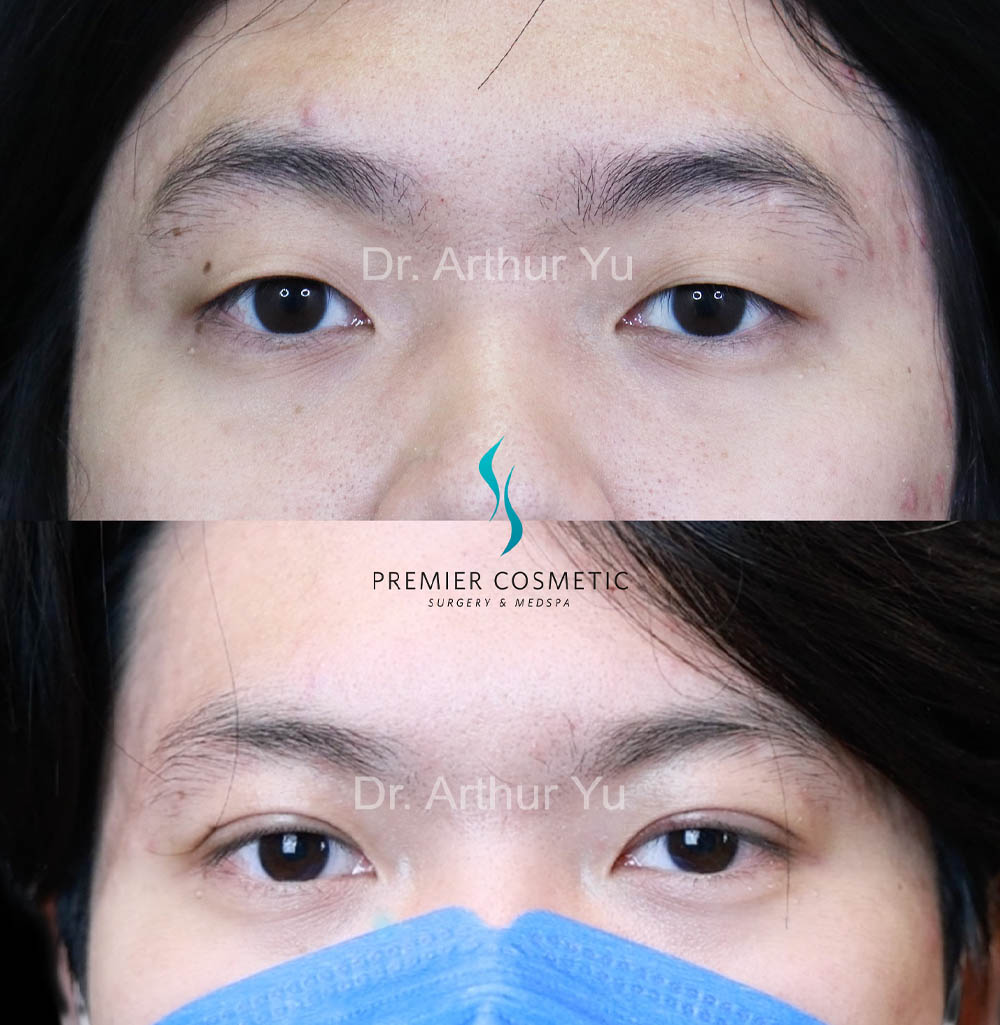 Upper Eyelid Surgery case #18069