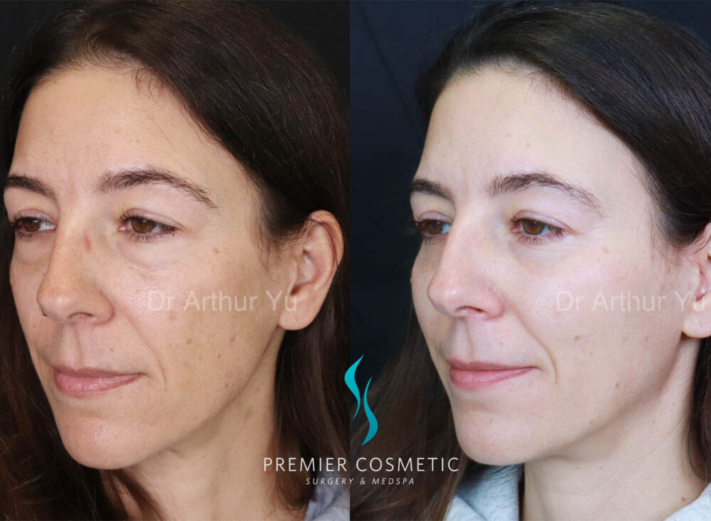 Lower Eyebag Surgery case #18033