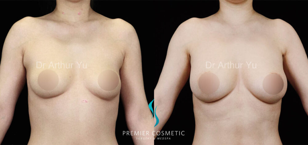 Breast Fat Grafting case #17967
