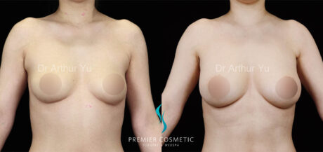 Breast Fat Grafting case #17967