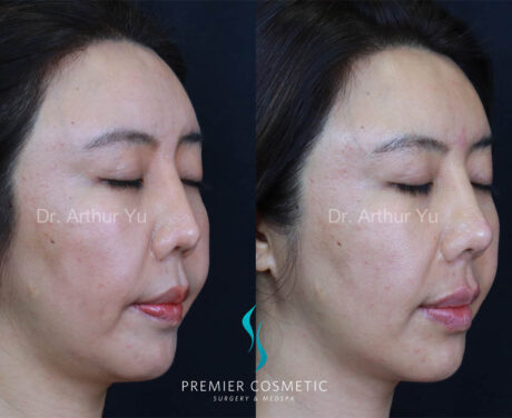 Art TipLyft® case #17910