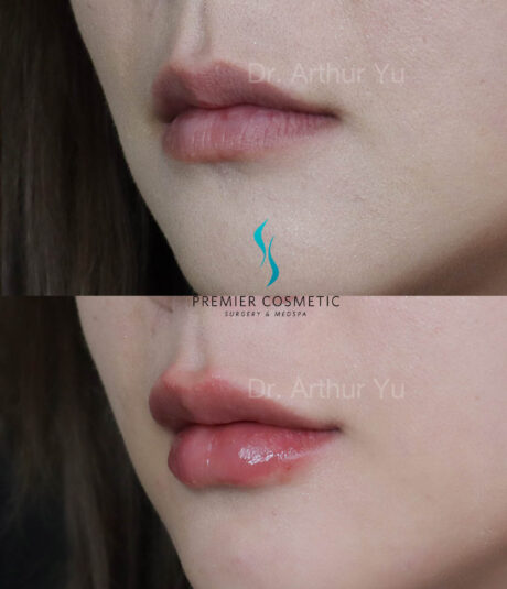 Lip Filler case #18009