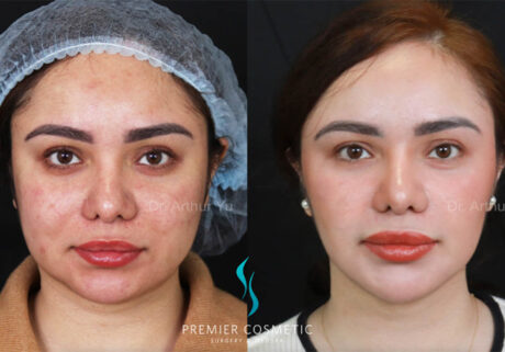 Buccal Fat Removal case #17991