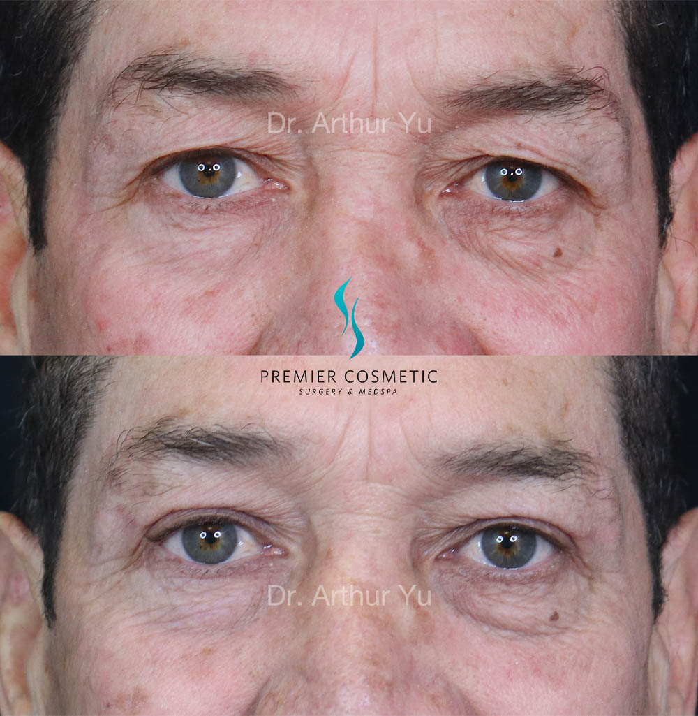 Upper Eyelid Surgery case #18075