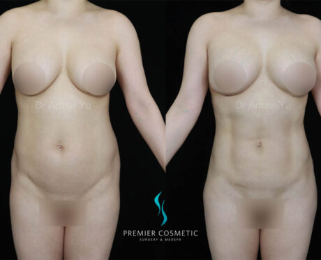 Liposculpture case #18015