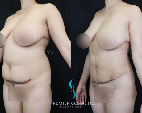 Tummy Tuck case #18064