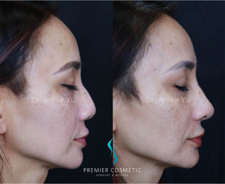 Art TipLyft® case #17908