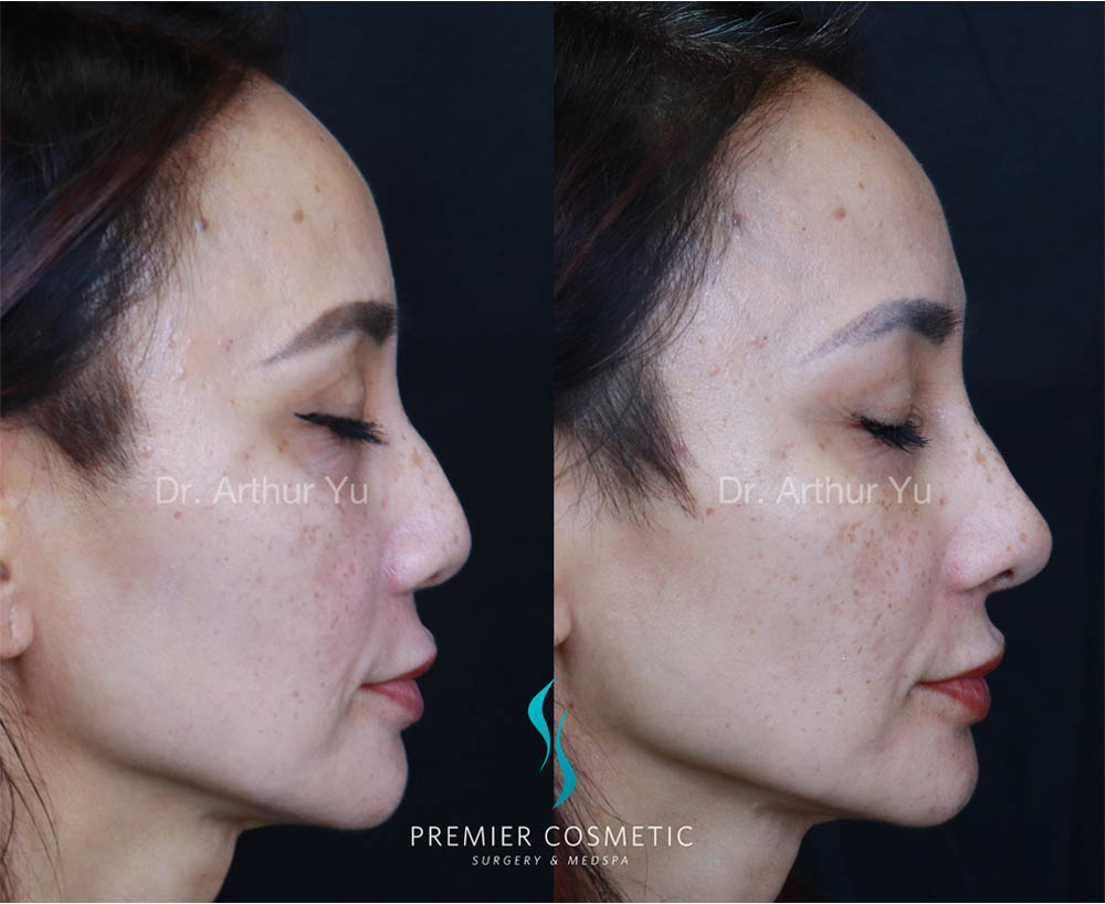 Art TipLyft® case #17908