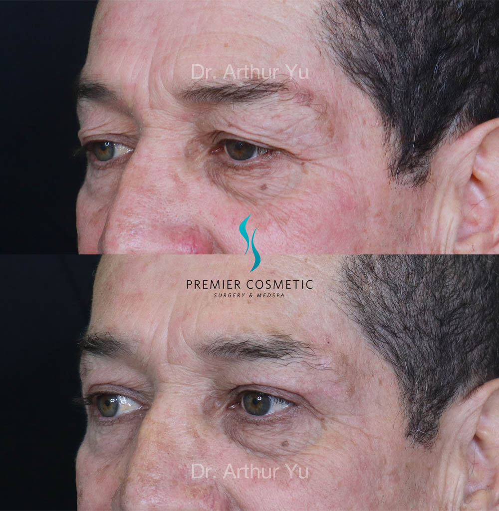 Upper Eyelid Surgery case #18077