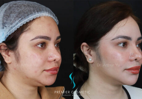 Buccal Fat Removal case #17989