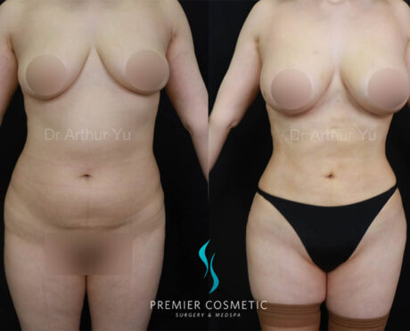 Liposculpture case #18017