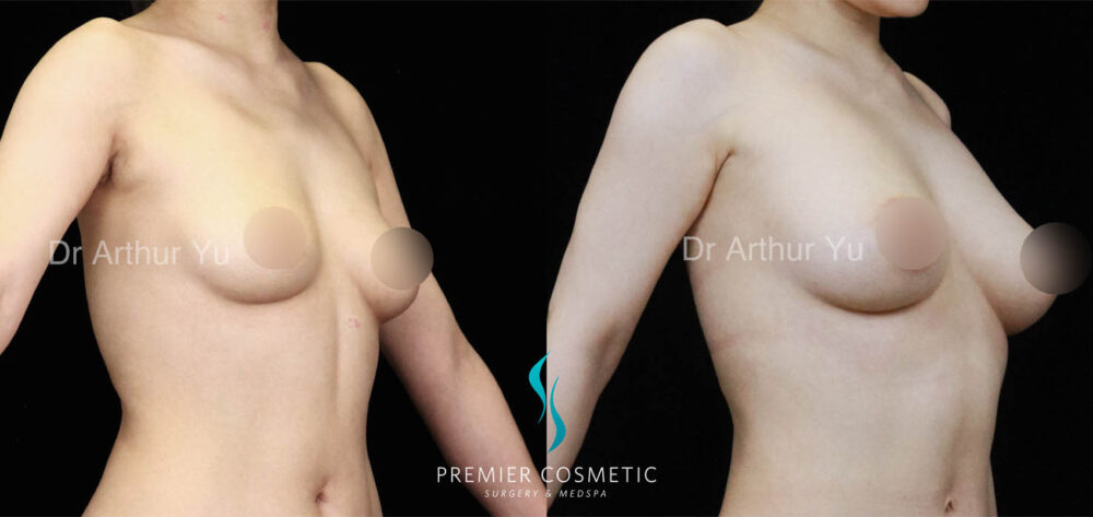 Breast Fat Grafting case #17965