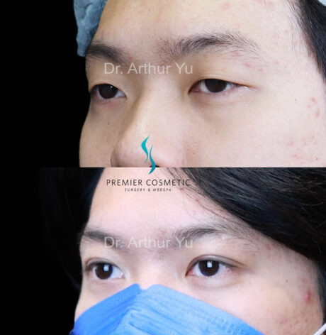 Upper Eyelid Surgery case #18071