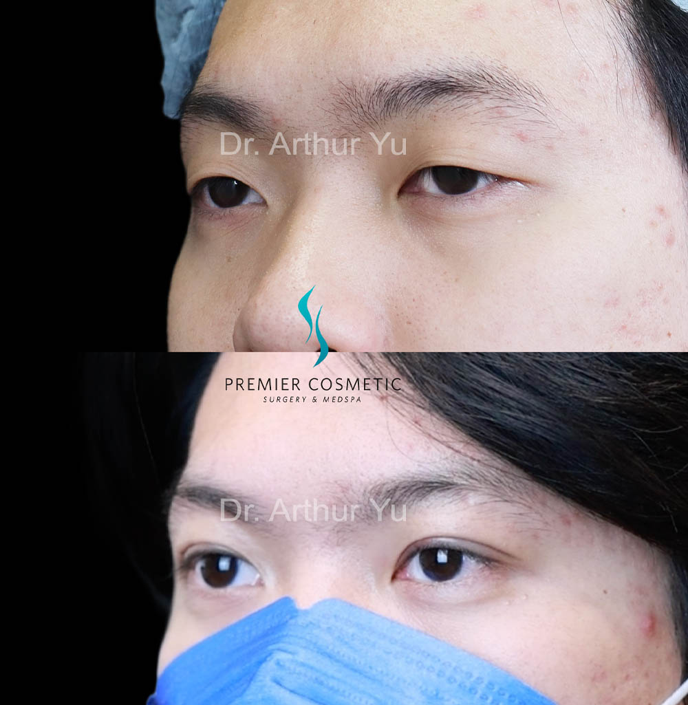 Upper Eyelid Surgery case #18071