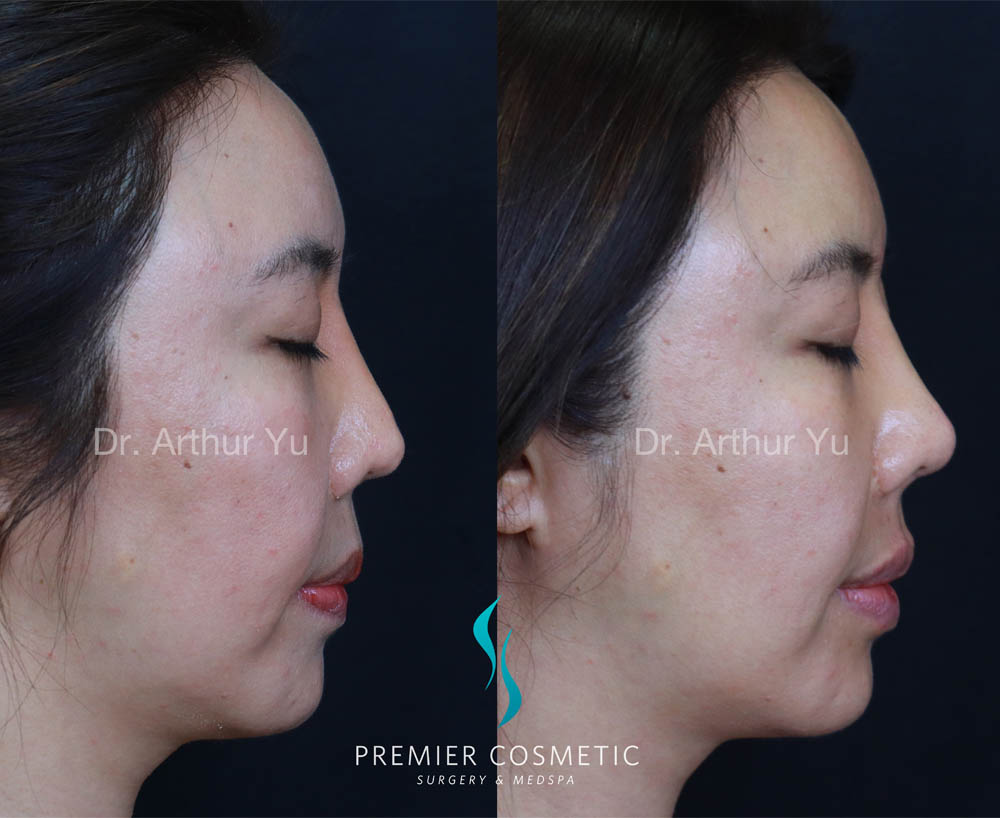 Art TipLyft® case #17912