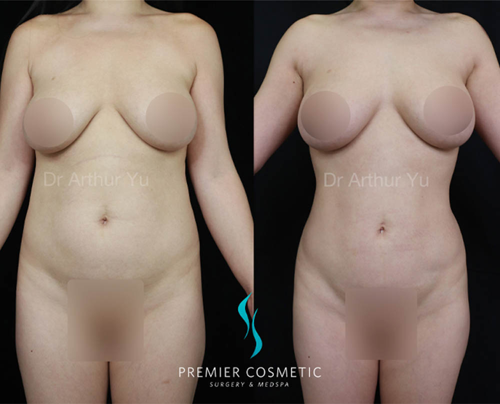 Liposculpture case #18019