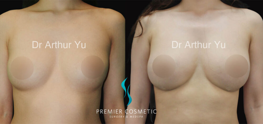 Breast Fat Grafting case #17963