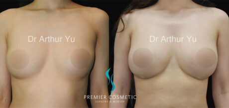 Breast Fat Grafting case #17963