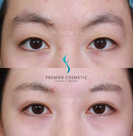 Upper Eyelid Surgery case #18073