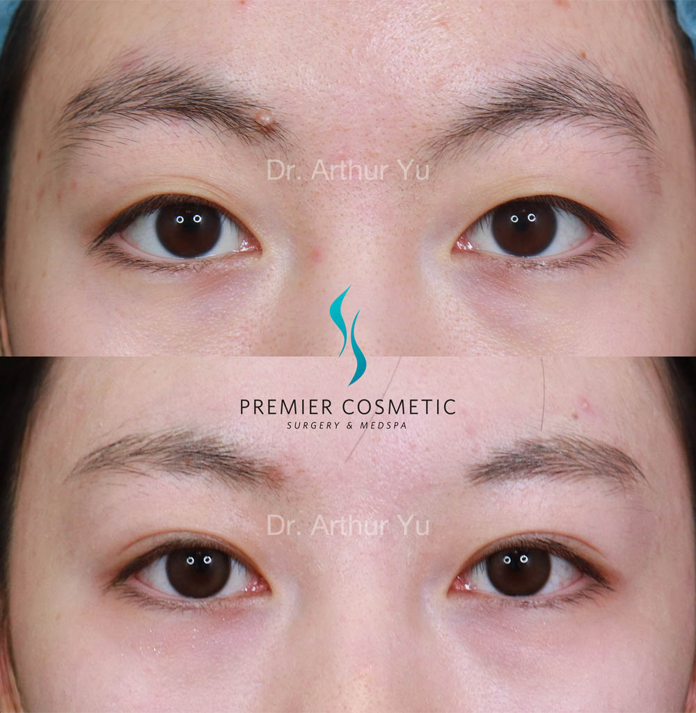 Upper Eyelid Surgery case #18073