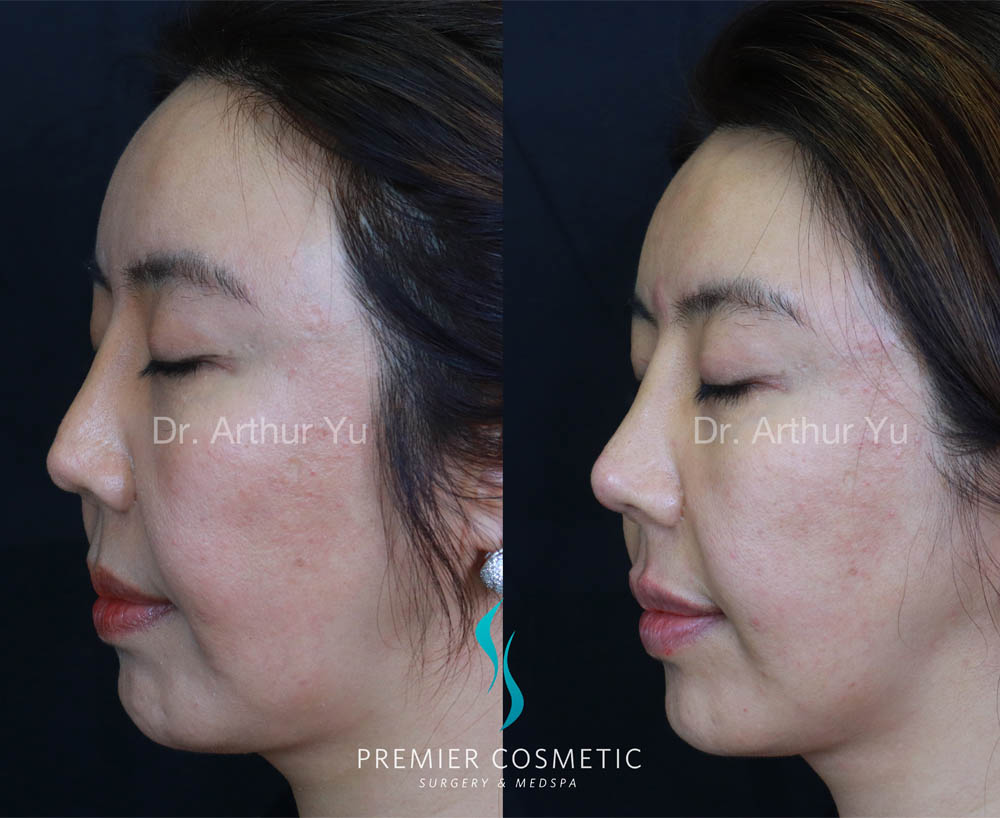 Art TipLyft® case #17914