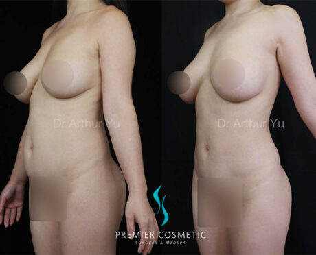 Liposculpture case #18021