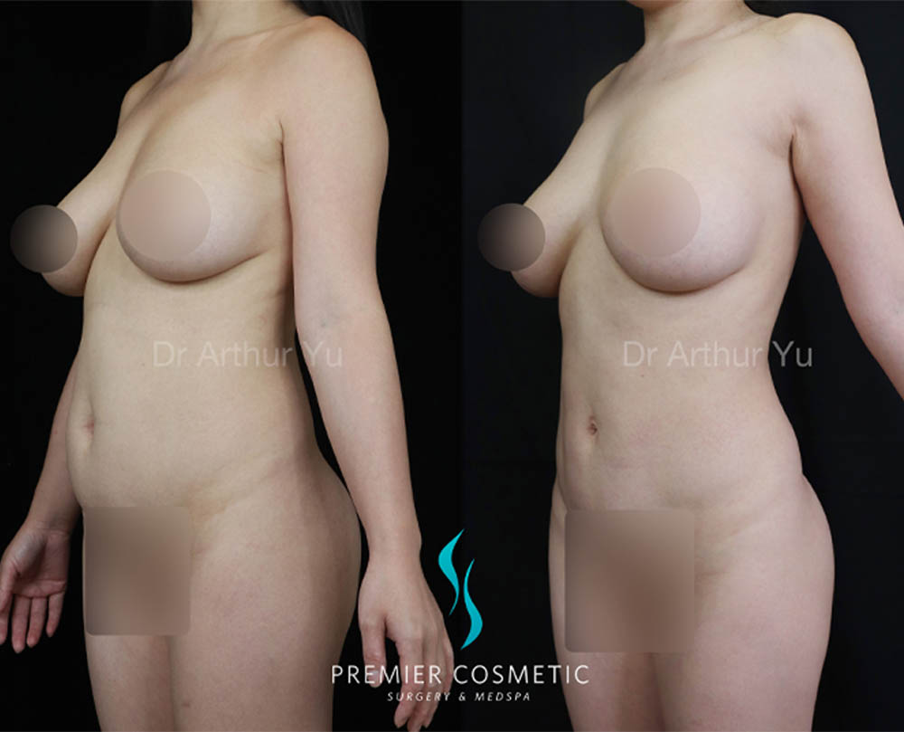 Liposculpture case #18021