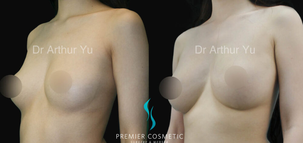 Breast Fat Grafting case #17961