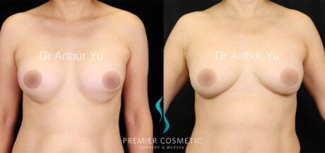 Breast Fat Grafting case #17959