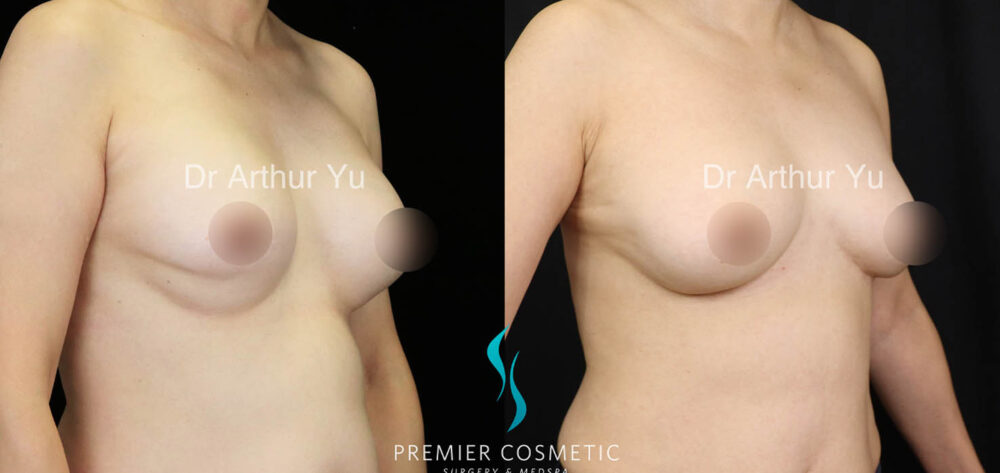 Breast Fat Grafting case #17957