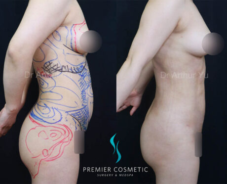 Liposculpture case #18027