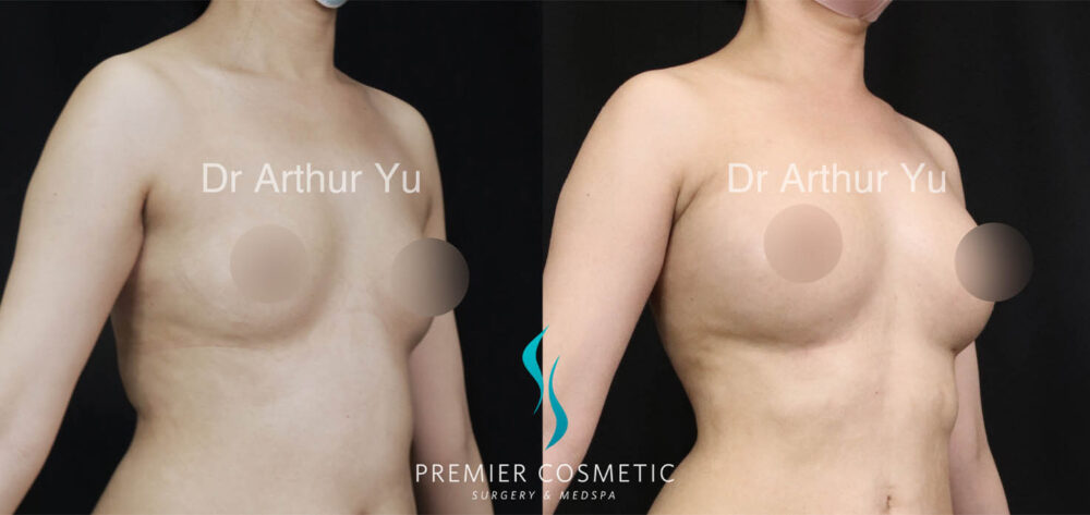 Breast Fat Grafting case #17955