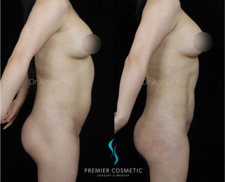 Liposculpture case #18029